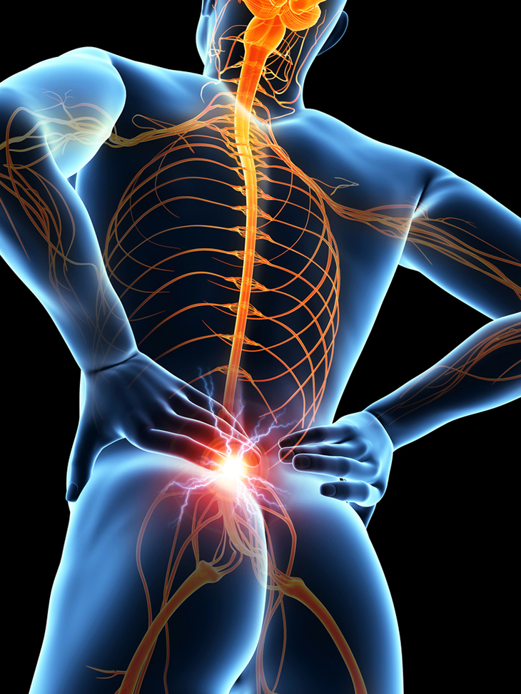 Piriformis Syndrome, Buttock Pain, Physical Therapy