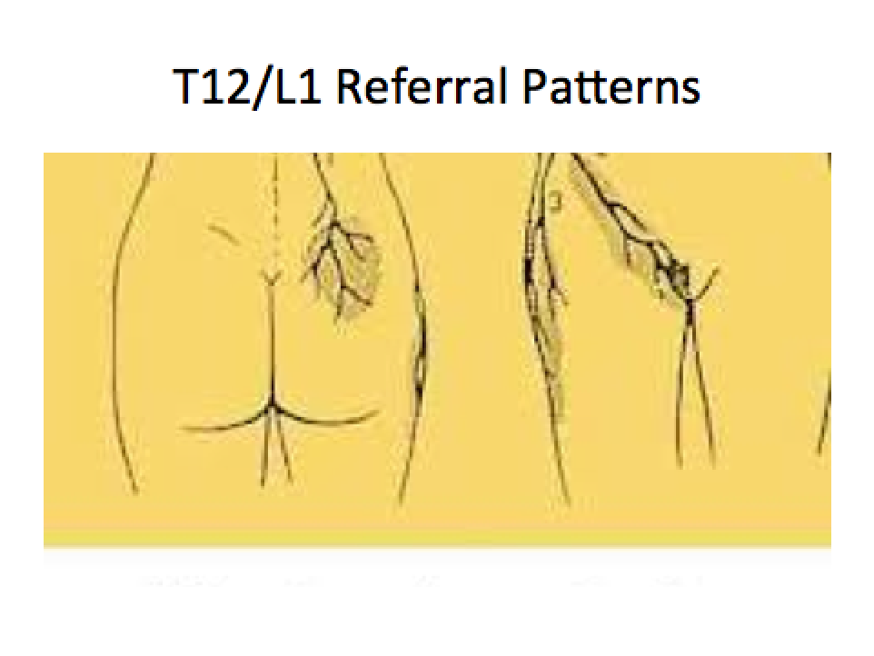 T12/L1 Referral Patterns