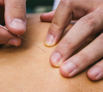 Learn the differences between acupuncture and dry needling